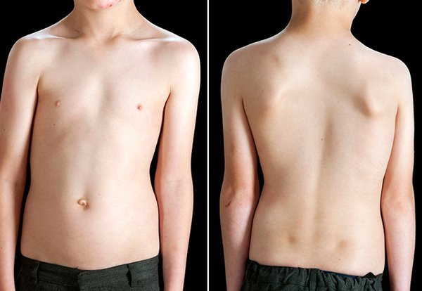 Boy with Scoliose